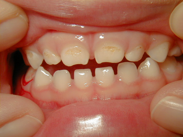 2歳児の虫歯